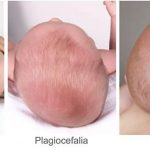 plagiocefalia y braquiocefalia