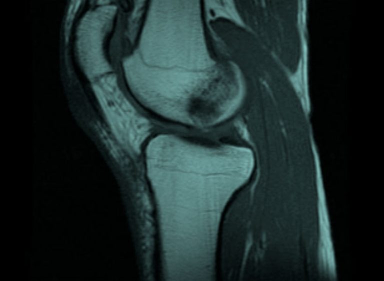 El Edema Óseo, acumulación de fluidos en el tejido oseo