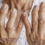 Síntomas y señales más frecuentes si padeces de artrosis